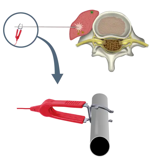 Illustration: Usage of stimulation clip